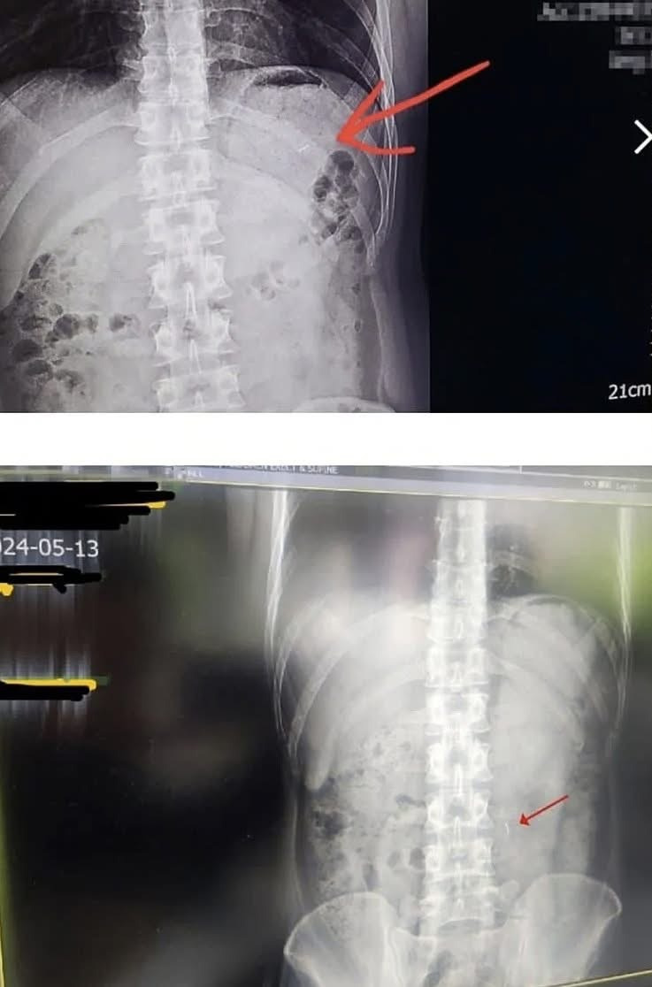 소고기먹다가-주사바늘-나옴-7-이미지