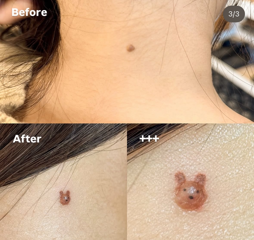 튀어나온-점-곰돌이로-만드는-타투-1-이미지