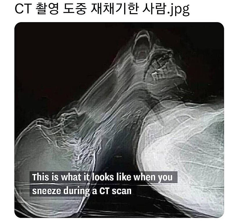 CT-촬영중-재채기하면-일케-됨-0-이미지