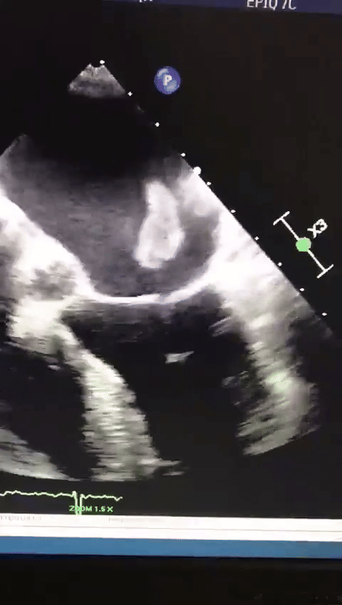 심장-판막에서-뛰고있는-혈전-0-이미지