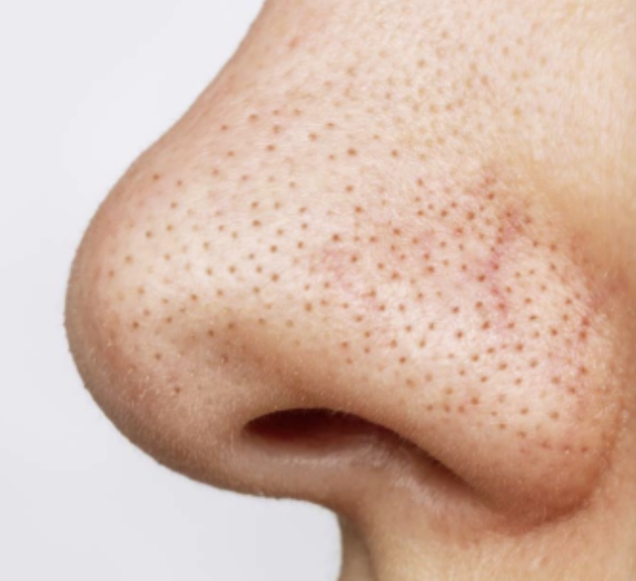 7년차-피부과-직원이-말해준-피부고민별-관리비법(모공,여드름,노화,수분,블랙헤드)-16-이미지