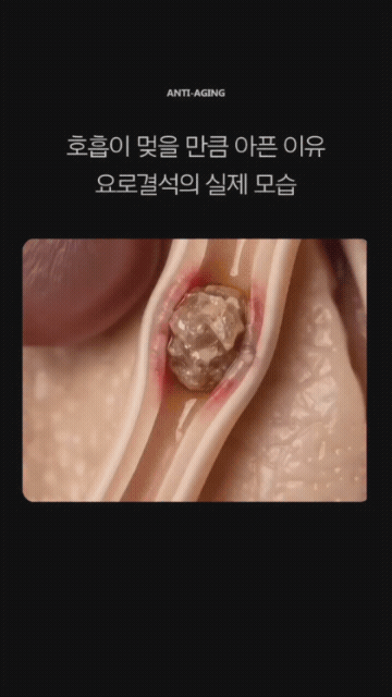 요로결석이-매우-아픈-이유-1-이미지