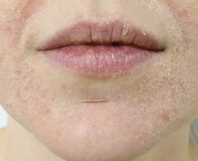 7년차-피부과-직원이-말해준-피부고민별-관리비법(모공,여드름,노화,수분,블랙헤드)-12-이미지