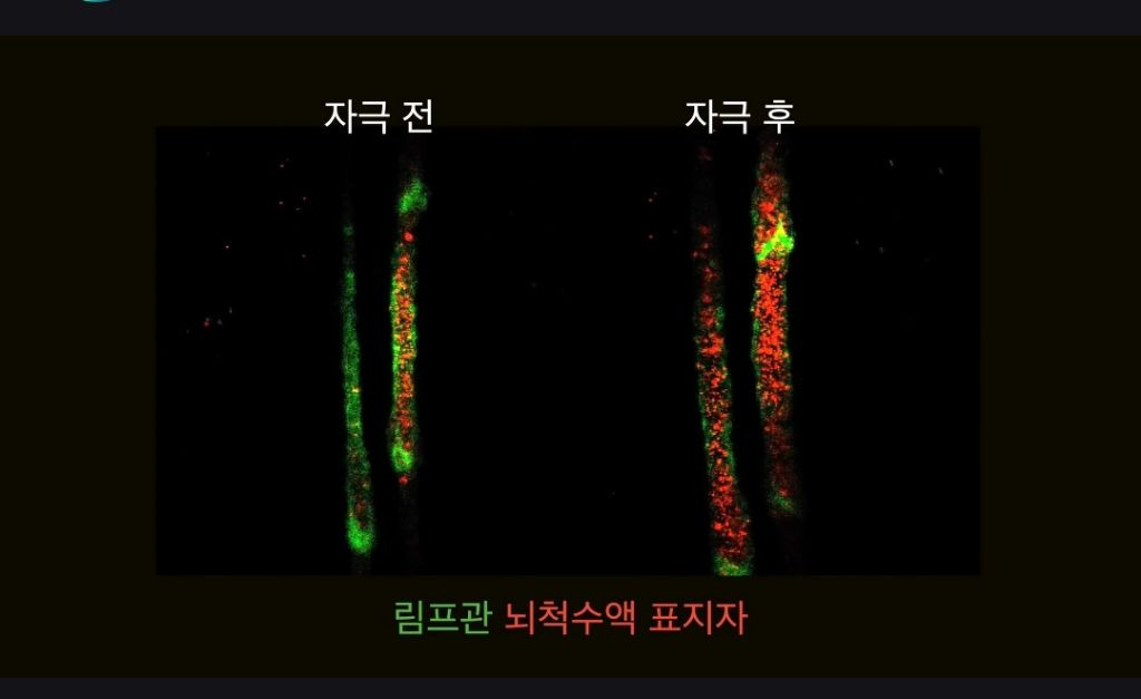 마사지로-뇌-노폐물-배출하여-치매-예방-5-이미지