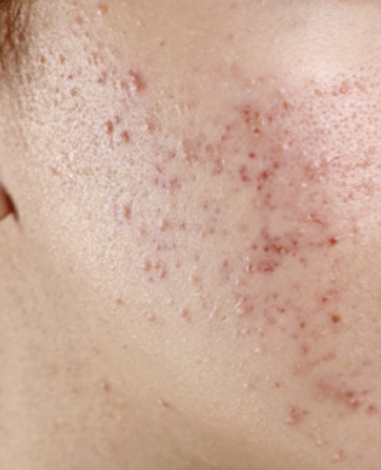 7년차-피부과-직원이-말해준-피부고민별-관리비법(모공,여드름,노화,수분,블랙헤드)-6-이미지