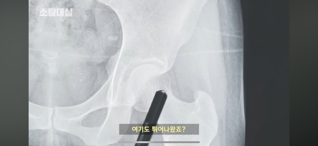 태생부터-다리찢기를-하면-안되는-고관절이-있음-21-이미지