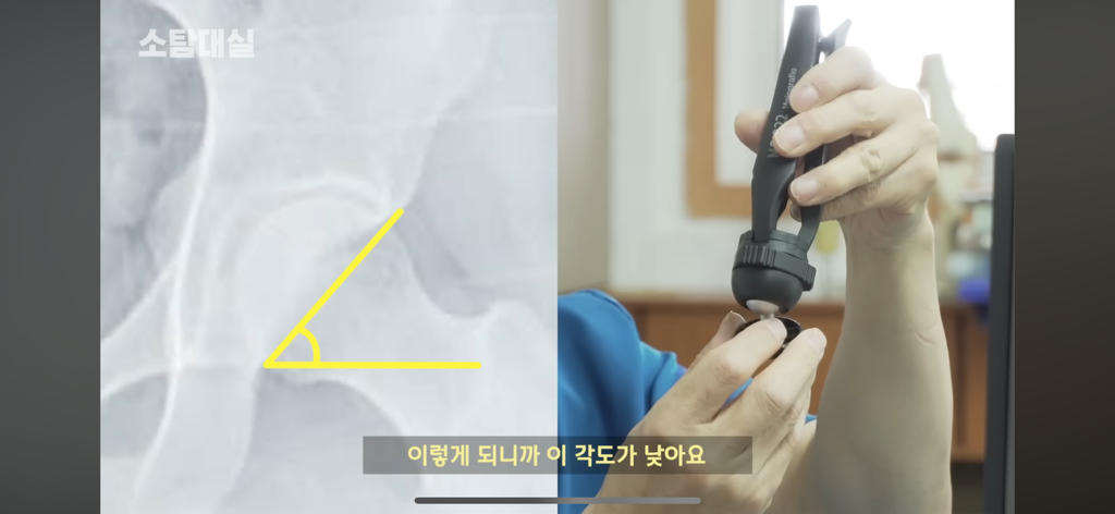 태생부터-다리찢기를-하면-안되는-고관절이-있음-26-이미지