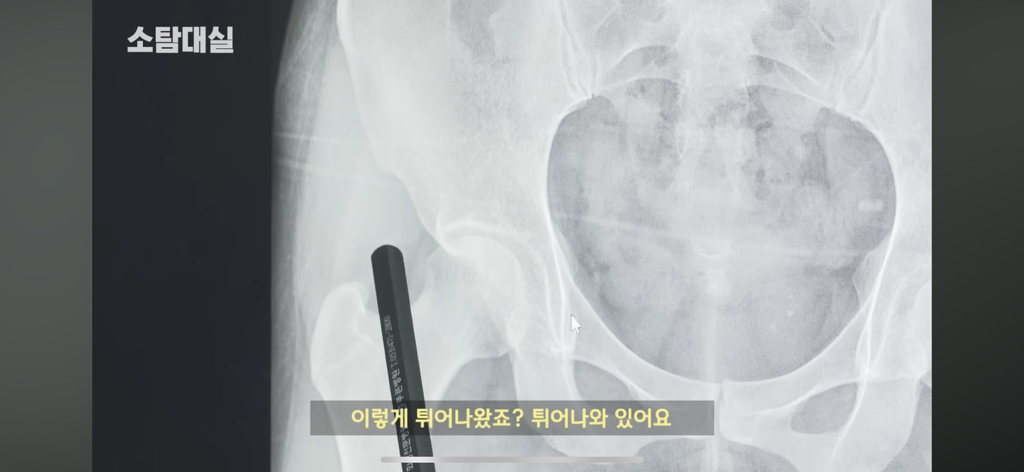 태생부터-다리찢기를-하면-안되는-고관절이-있음-20-이미지