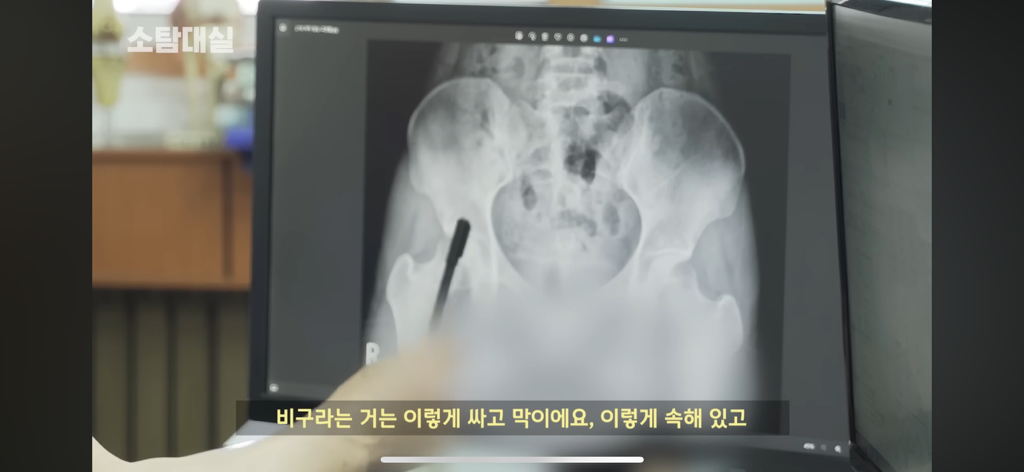 태생부터-다리찢기를-하면-안되는-고관절이-있음-1-이미지