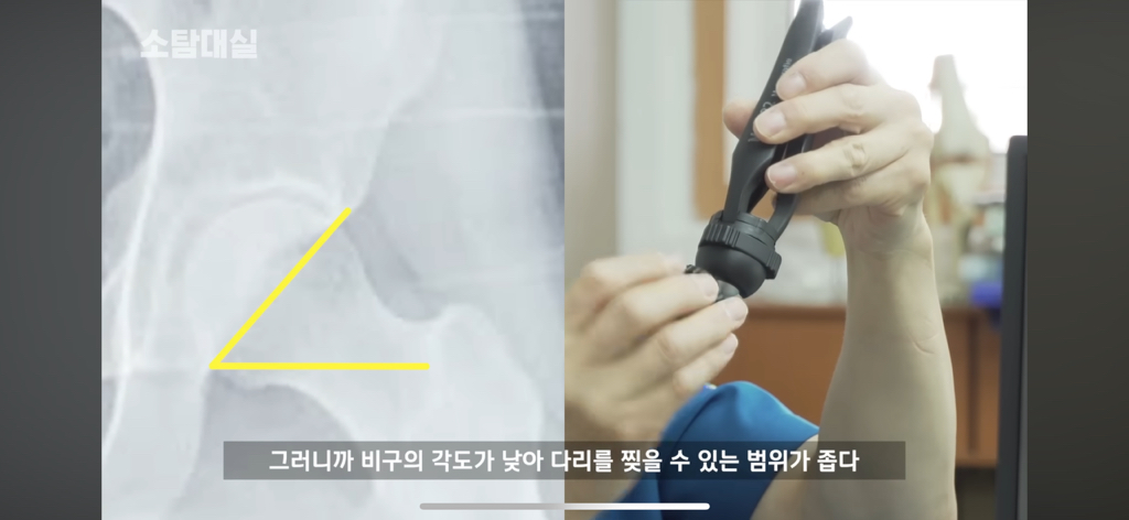 태생부터-다리찢기를-하면-안되는-고관절이-있음-42-이미지