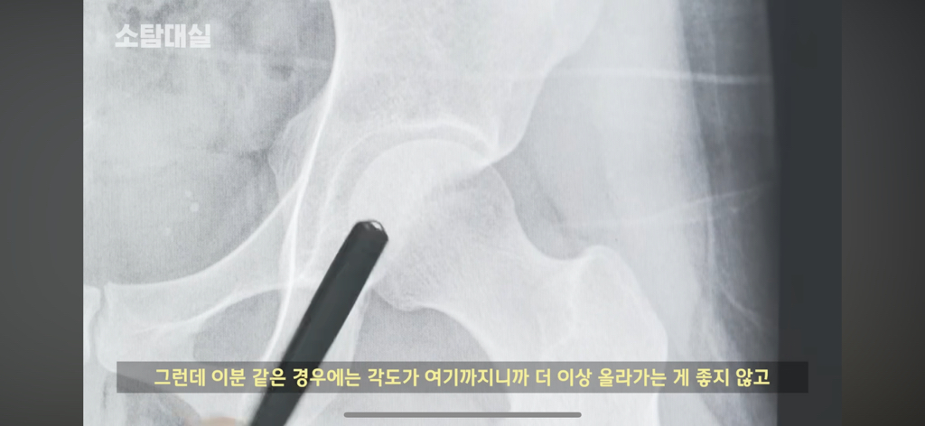 태생부터-다리찢기를-하면-안되는-고관절이-있음-28-이미지