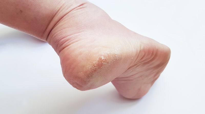 생각보다-많다는-사람들의-발-상태-1-이미지