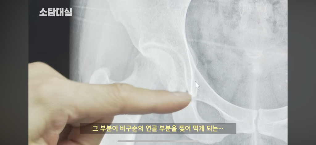 태생부터-다리찢기를-하면-안되는-고관절이-있음-24-이미지