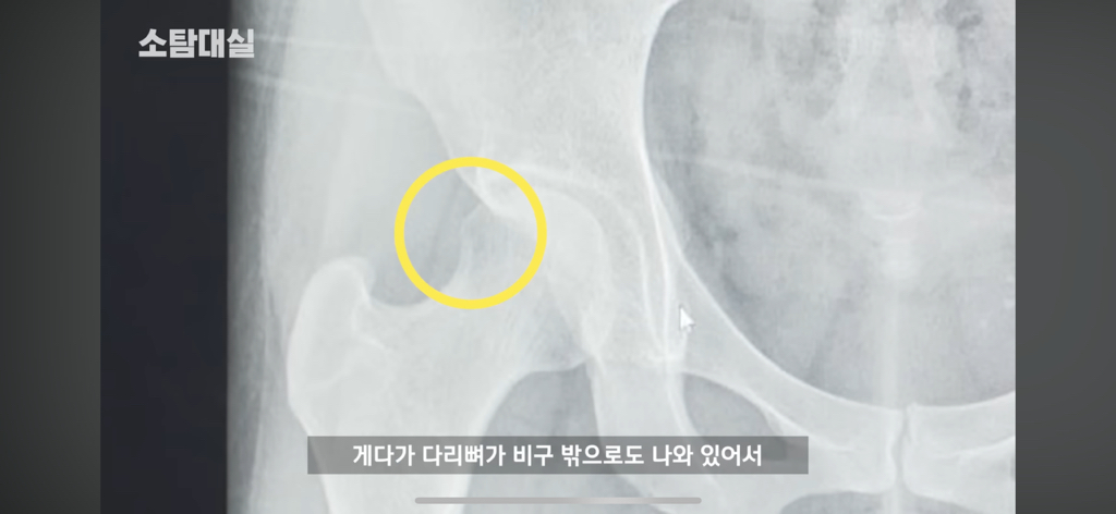 태생부터-다리찢기를-하면-안되는-고관절이-있음-43-이미지