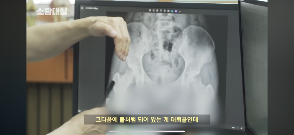 태생부터-다리찢기를-하면-안되는-고관절이-있음-2-이미지