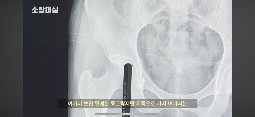 태생부터-다리찢기를-하면-안되는-고관절이-있음-19-이미지
