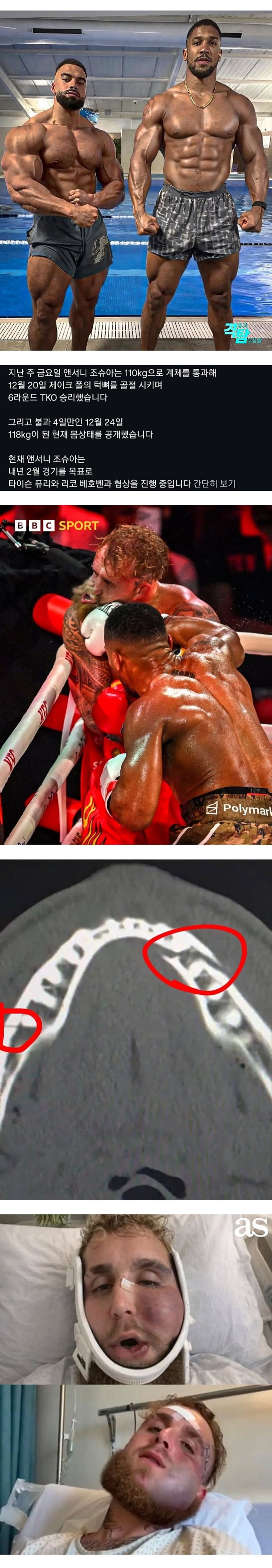 앤서니-조슈아-최근-몸상태-1-이미지