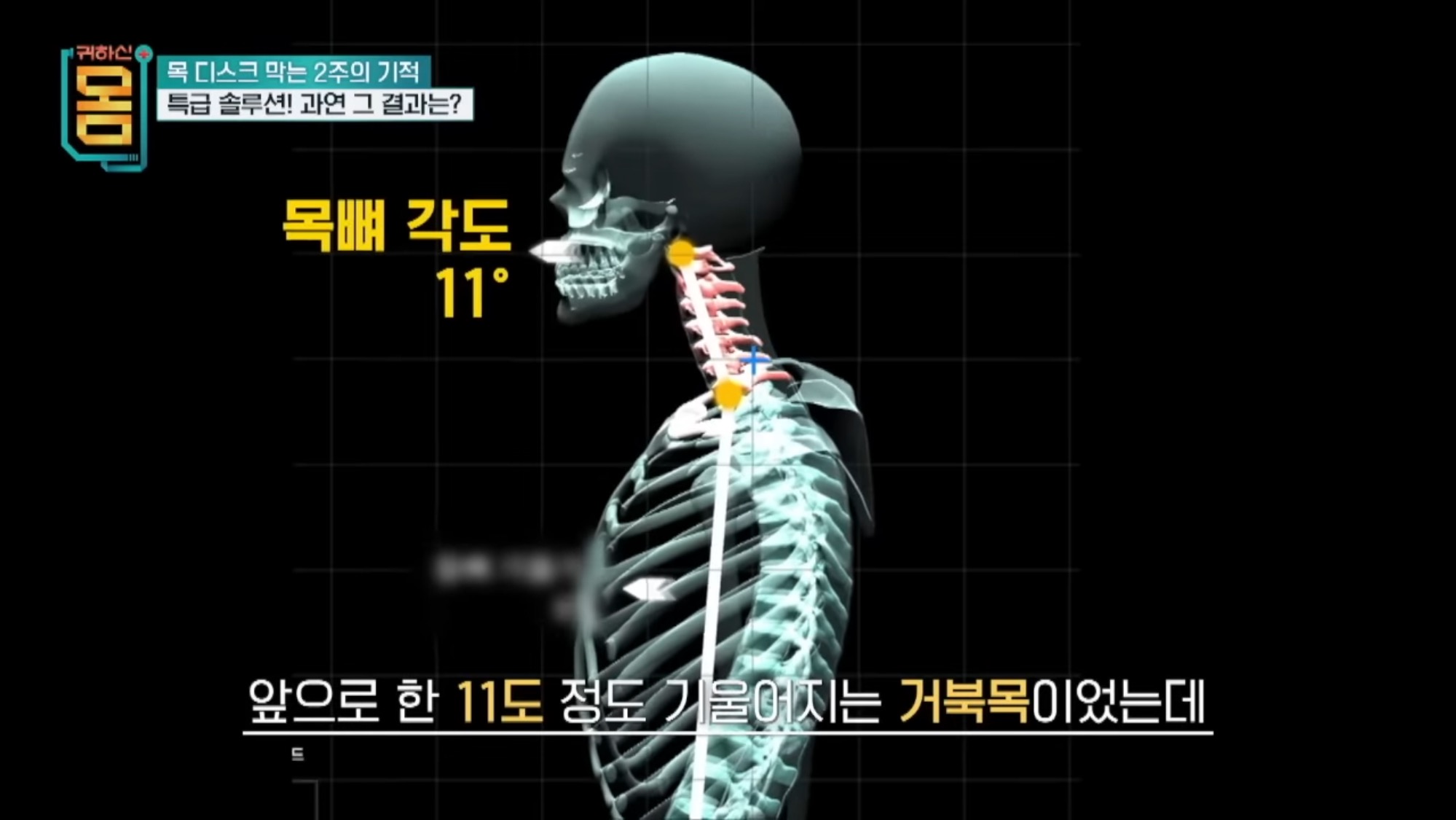 2주만에-효과-대박인-거북목•일자목-마사지&운동-23-이미지