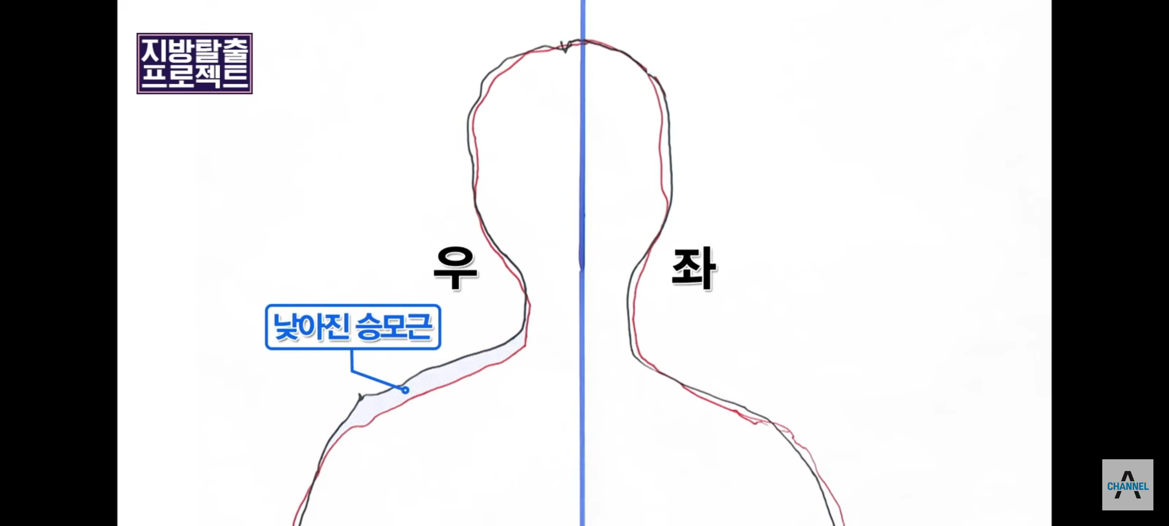 승모근-스트레칭-끝판왕-0-이미지