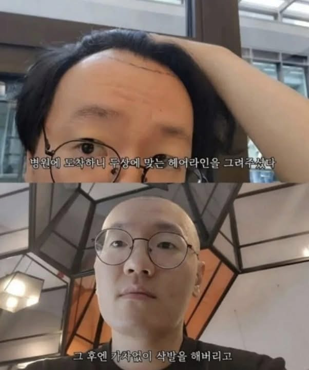 터키로-모발-이식-하러-간-사람에게-일어난-일-1-이미지