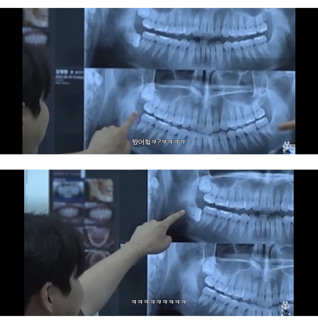 영케이-대단한-사랑니-0-이미지