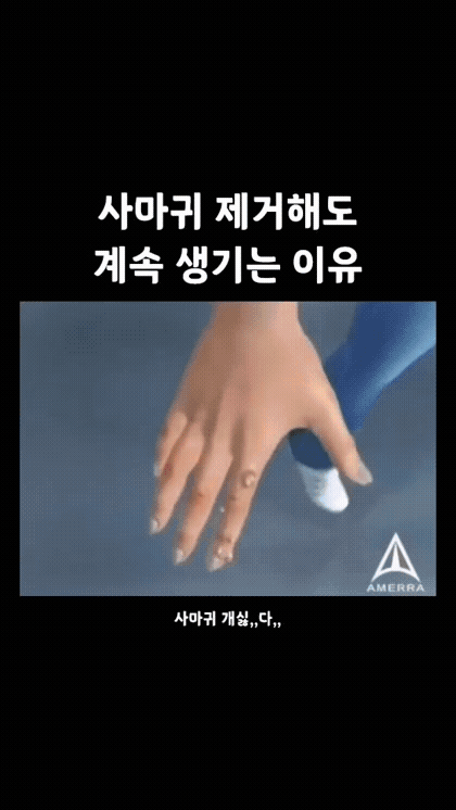 사마귀-제거해도-계속-생기는-이유-0-이미지