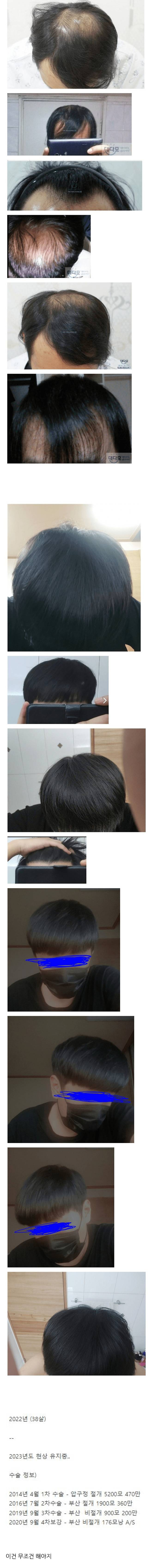 모발이식에-1000만원-투자한-38세-결과-0-이미지