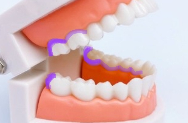 백날-열심히-칫솔질-치실질해도-안-닦이는-부분-있는-달글-(부제-:-첨단칫솔-쓰세요)-1-이미지