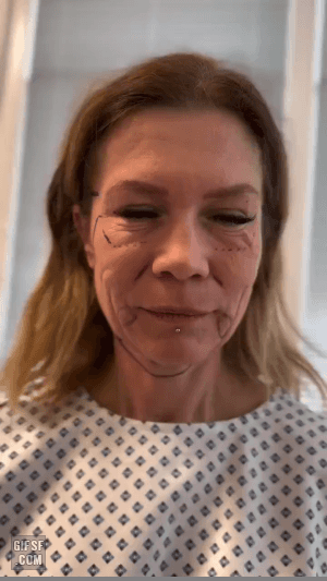 얼굴-리프팅-수술받은-여자-0-이미지