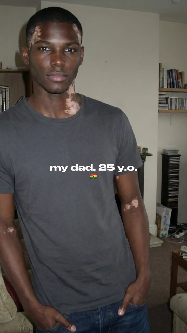 백인-엄마와-백반증-있는-흑인-아빠-사이에서-낳은-딸-1-이미지