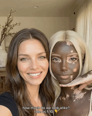 백인-엄마와-백반증-있는-흑인-아빠-사이에서-낳은-딸-9-이미지