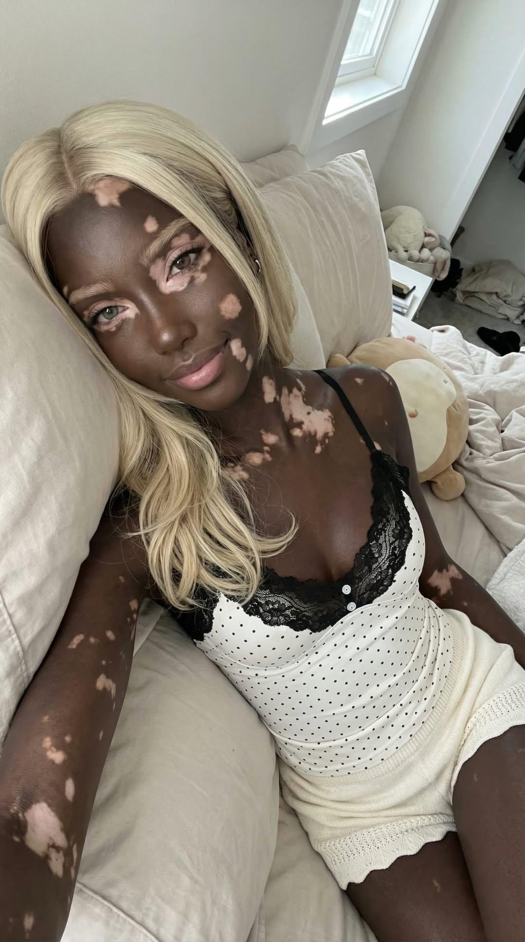 백인-엄마와-백반증-있는-흑인-아빠-사이에서-낳은-딸-16-이미지