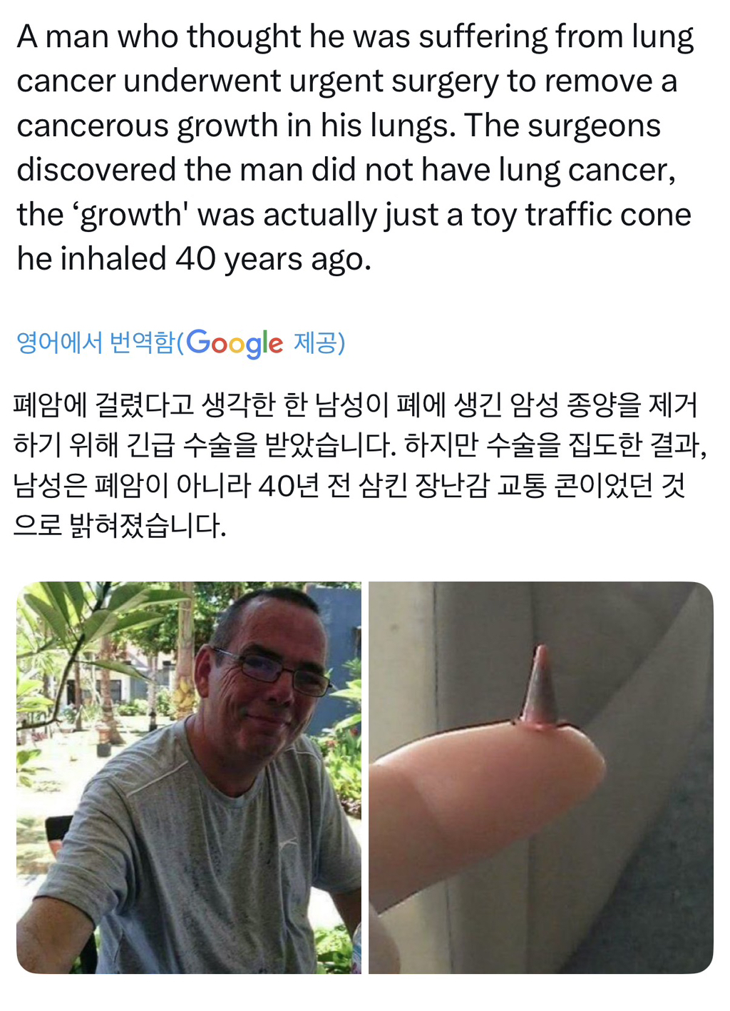 폐암인줄-알고-수술-후-폐암이-아니었던-걸로-밝혀진-남성-0-이미지