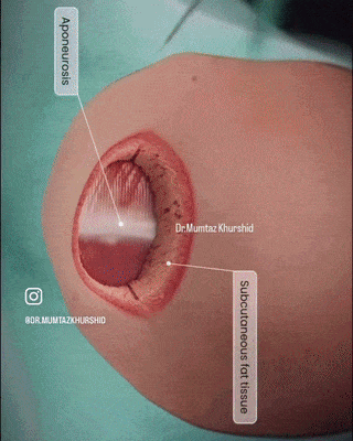 제왕절개-수술-과정.gif-0-이미지