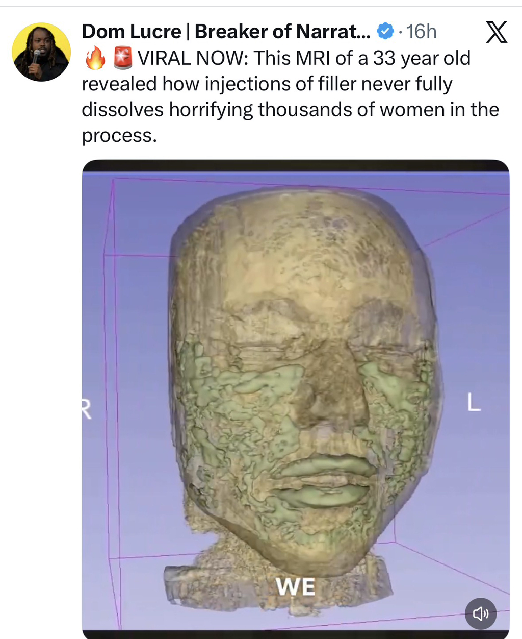 필러-얼굴에-넣은사람-MRI-모습-0-이미지