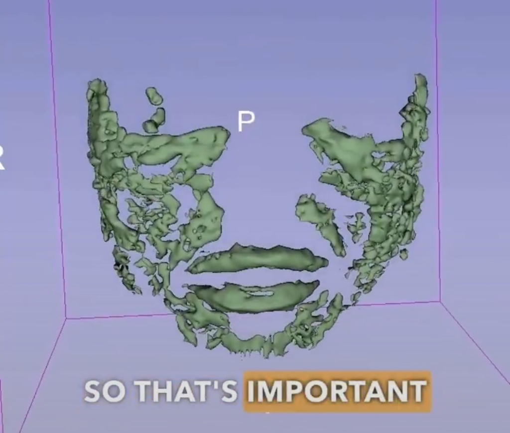 필러-얼굴에-넣은사람-MRI-모습-1-이미지
