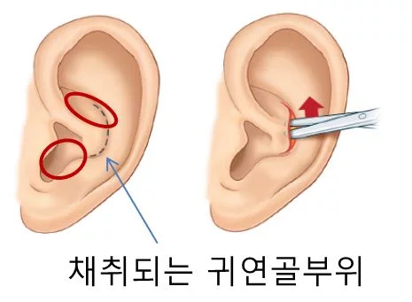 기기괴괴-그-자체인-요즘-유행한다는-코-수술-방법(약혐)-1-이미지