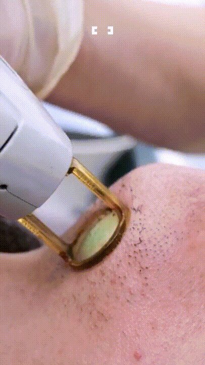 톡쏘는-시원함과-청량감이-있는-레이져제모-시술-0-이미지