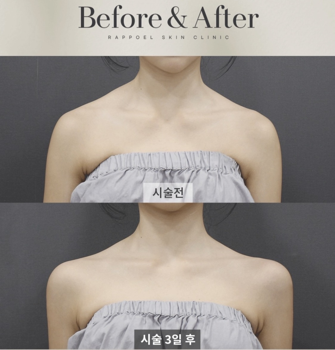 최근들어-직각어깨가-급-많아진-이유ㄷㄷㄷ-(f.조두팔)-4-이미지