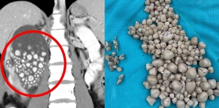맹물-대신-음료수만-마신-여성,-신장에서-‘돌’-300개-나왔다-0-이미지