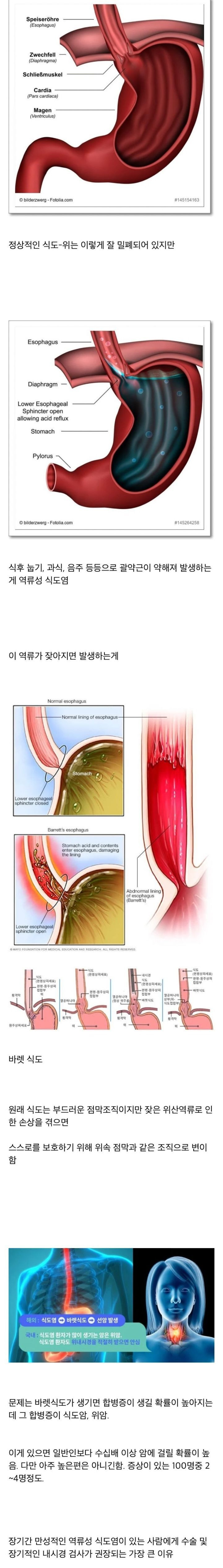 역류성-식도염을-방치하면-위험한-이유-0-이미지