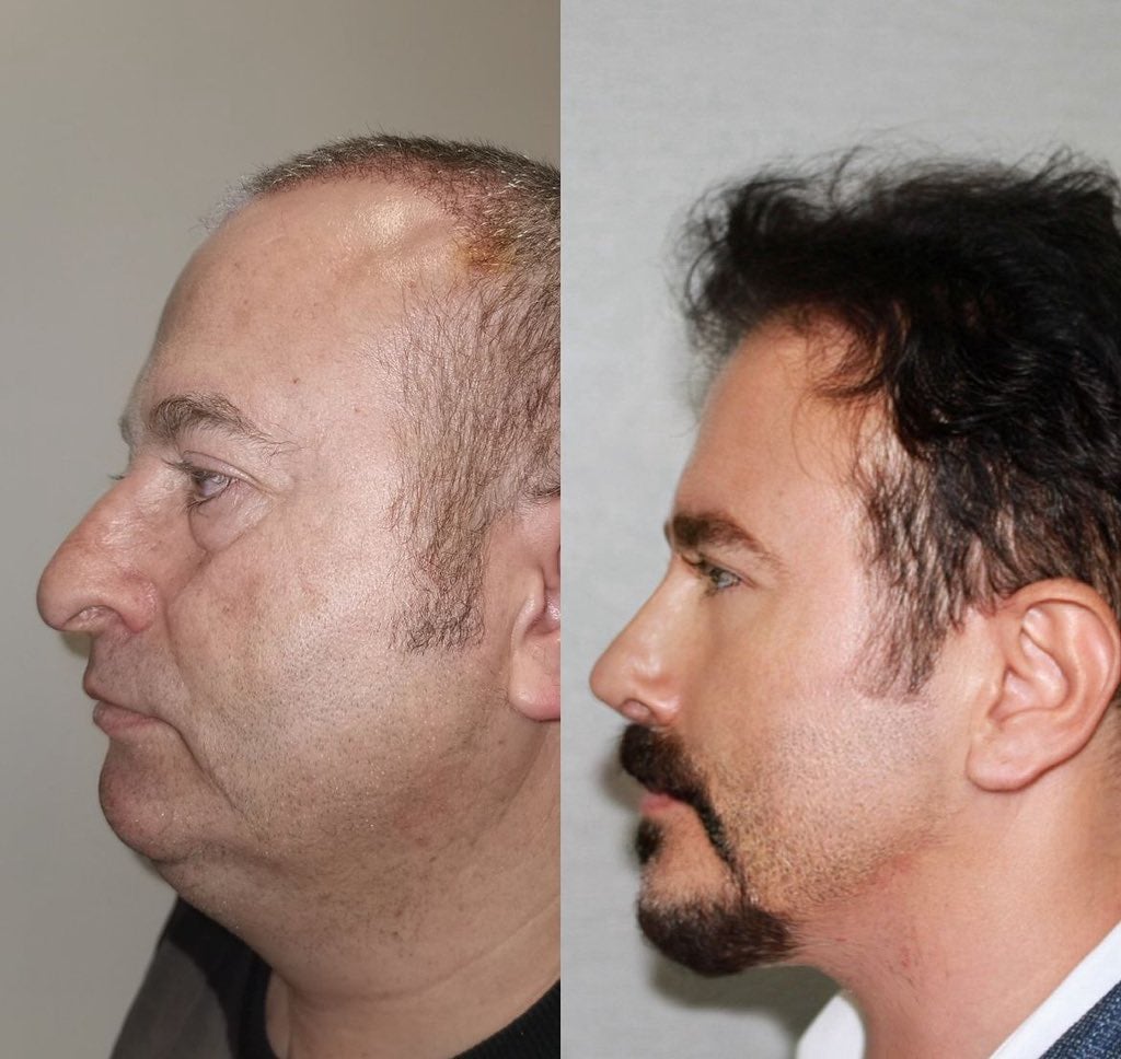 유럽에서-성형-하러-터키로-가는-이유-2-이미지