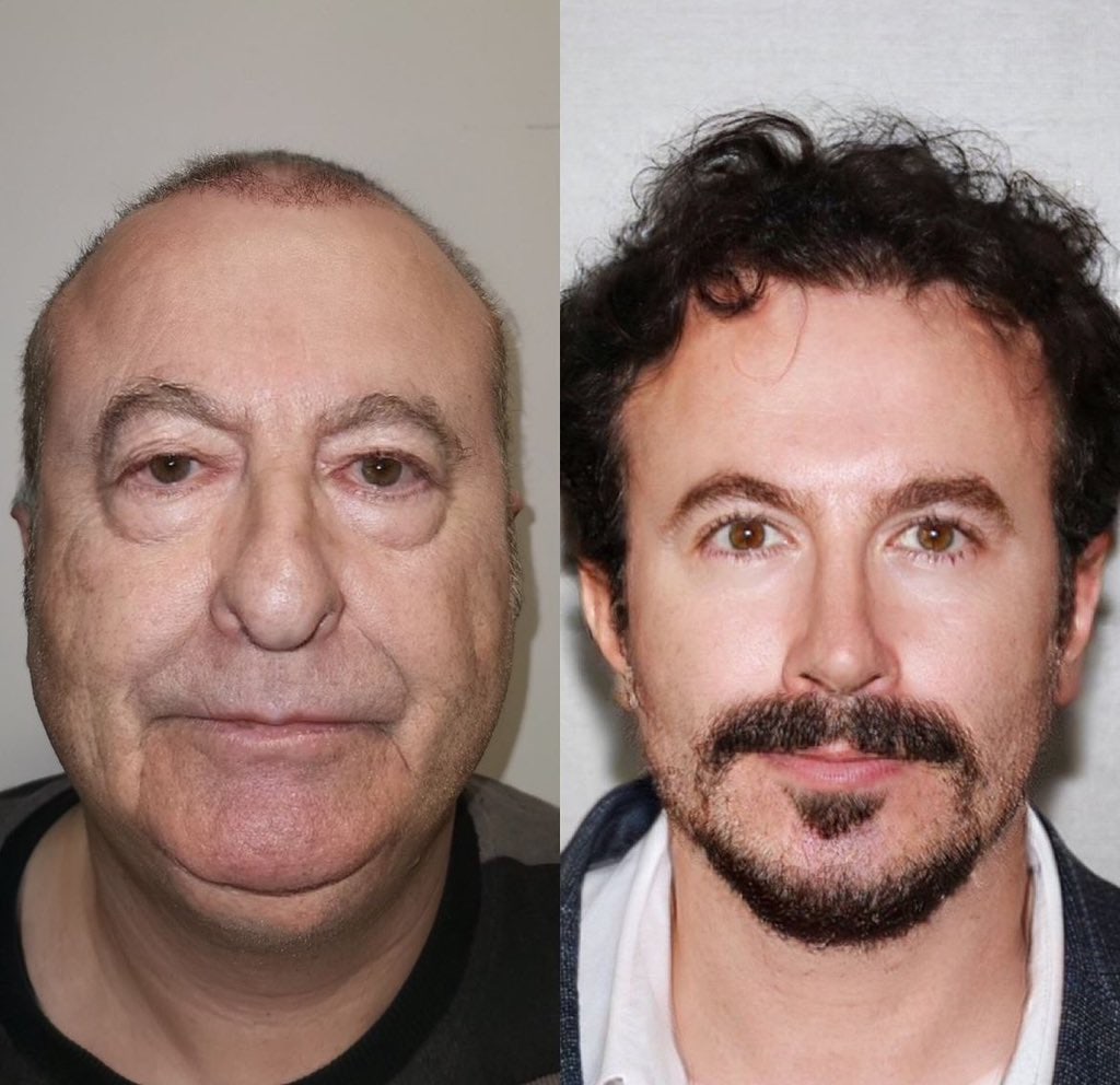 유럽에서-성형-하러-터키로-가는-이유-0-이미지