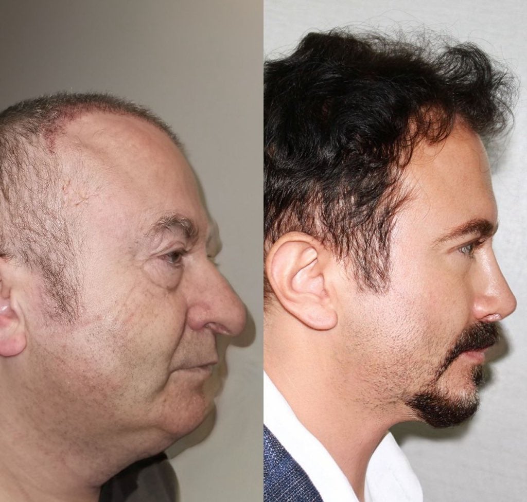 유럽에서-성형-하러-터키로-가는-이유-1-이미지