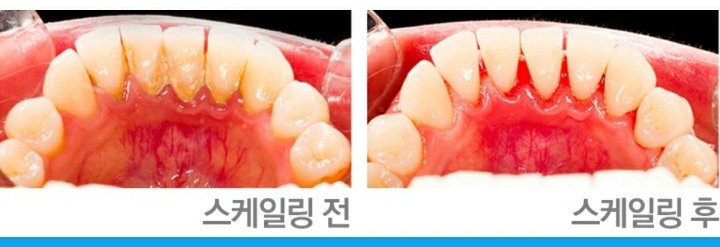 스케일링-너무-이시렵고-아프고-무서운-사람을-위한-극복하는-방법-4-이미지
