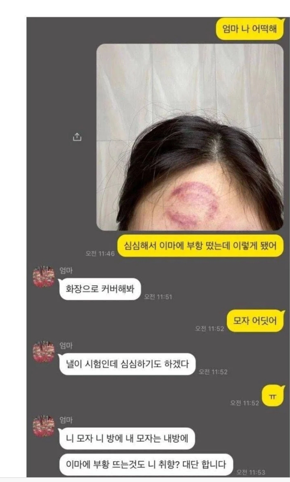 이마에-부항-잘못떴는데-엄마가..-0-이미지