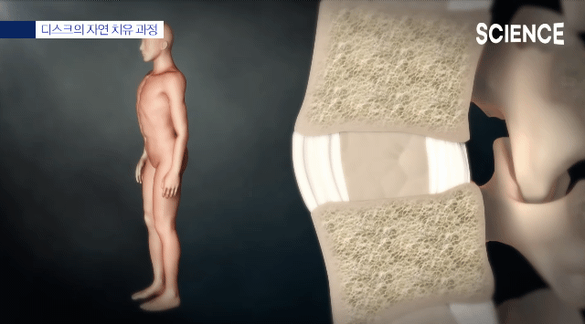 허리-디스크-:-통증의-간단한-이해-4-이미지