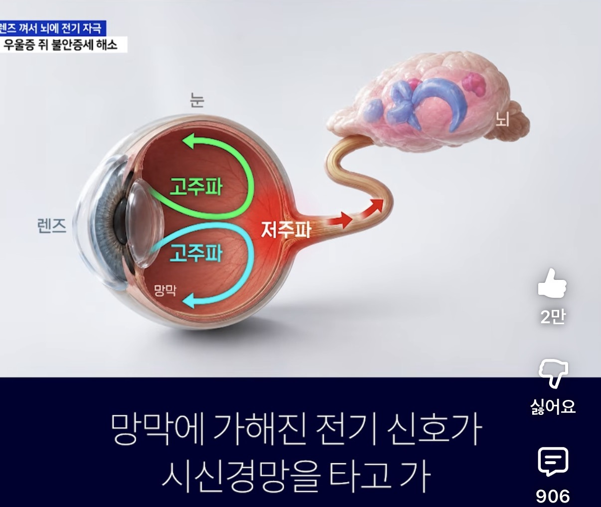 우울증치료용-렌즈-5-이미지