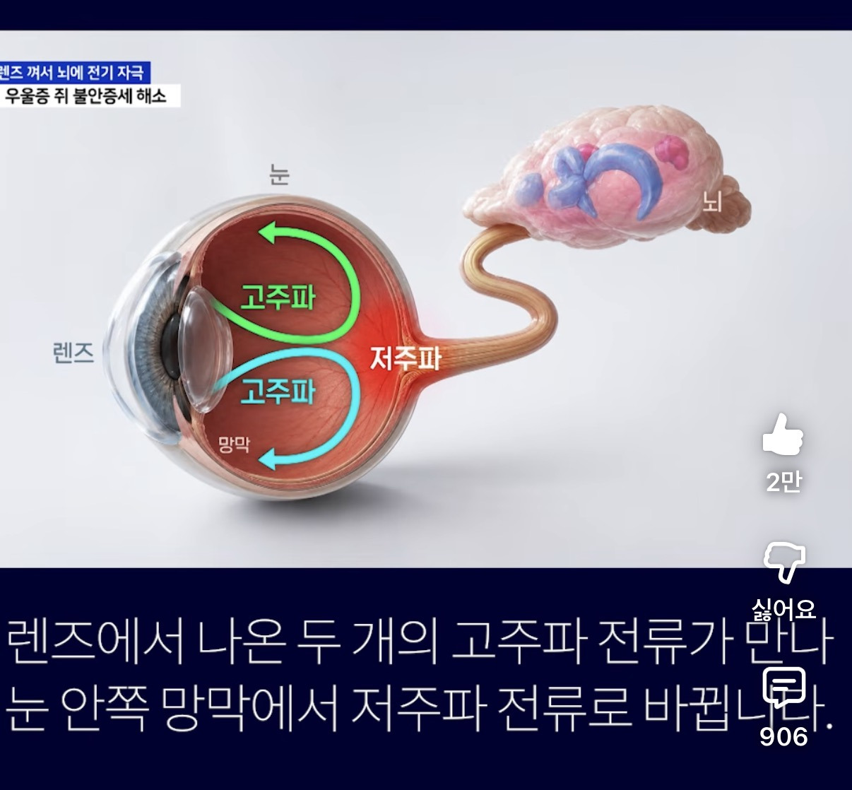우울증치료용-렌즈-4-이미지