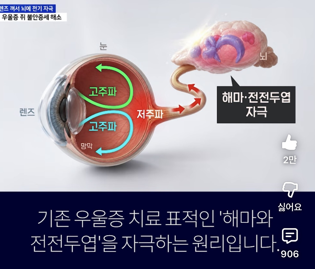 우울증치료용-렌즈-6-이미지